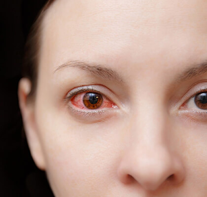 Woman suffering from Conjunctivitis